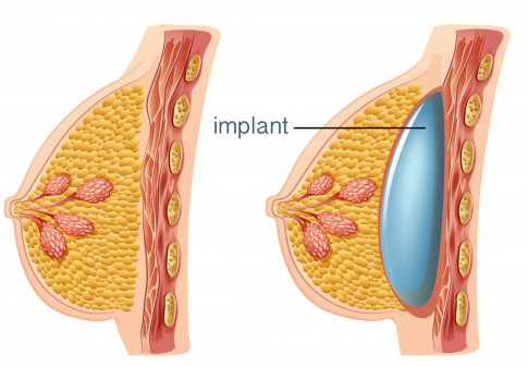 breast implant1