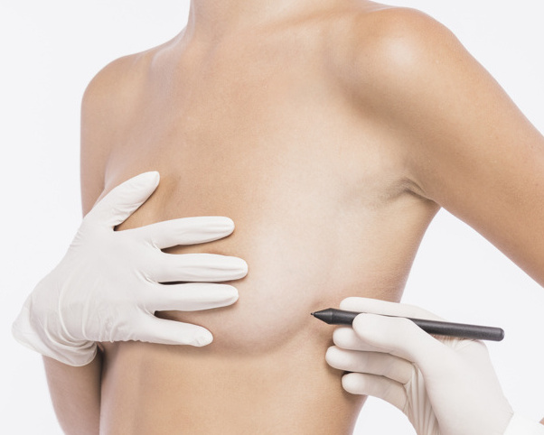 plastic surgeon drawing lines woman body